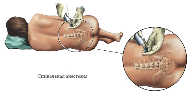 Спинальная анестезия или наркоз в позвоночник (насколько больно и как делается)