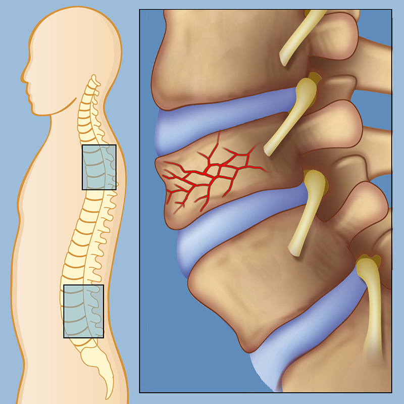 4 этапа лфк при переломе позвоночника