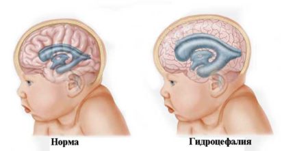 Симптоматика развития доброкачественной внутричерепной гипертензии у детей